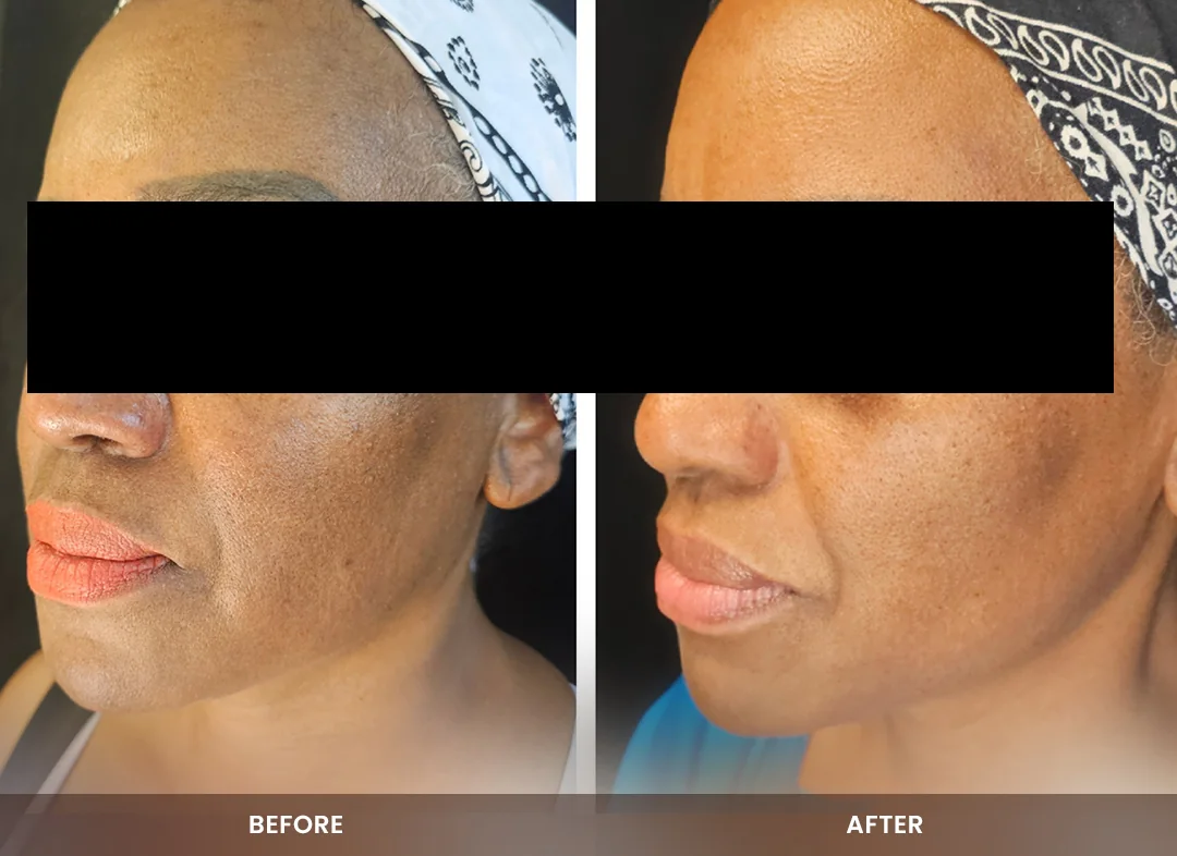 Skin Tightening before and after result — Face