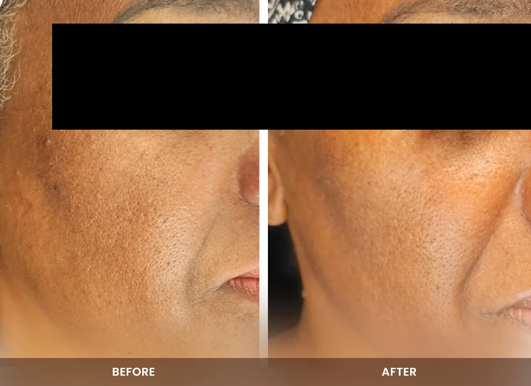 Skin Tightening before and after result — Cheek