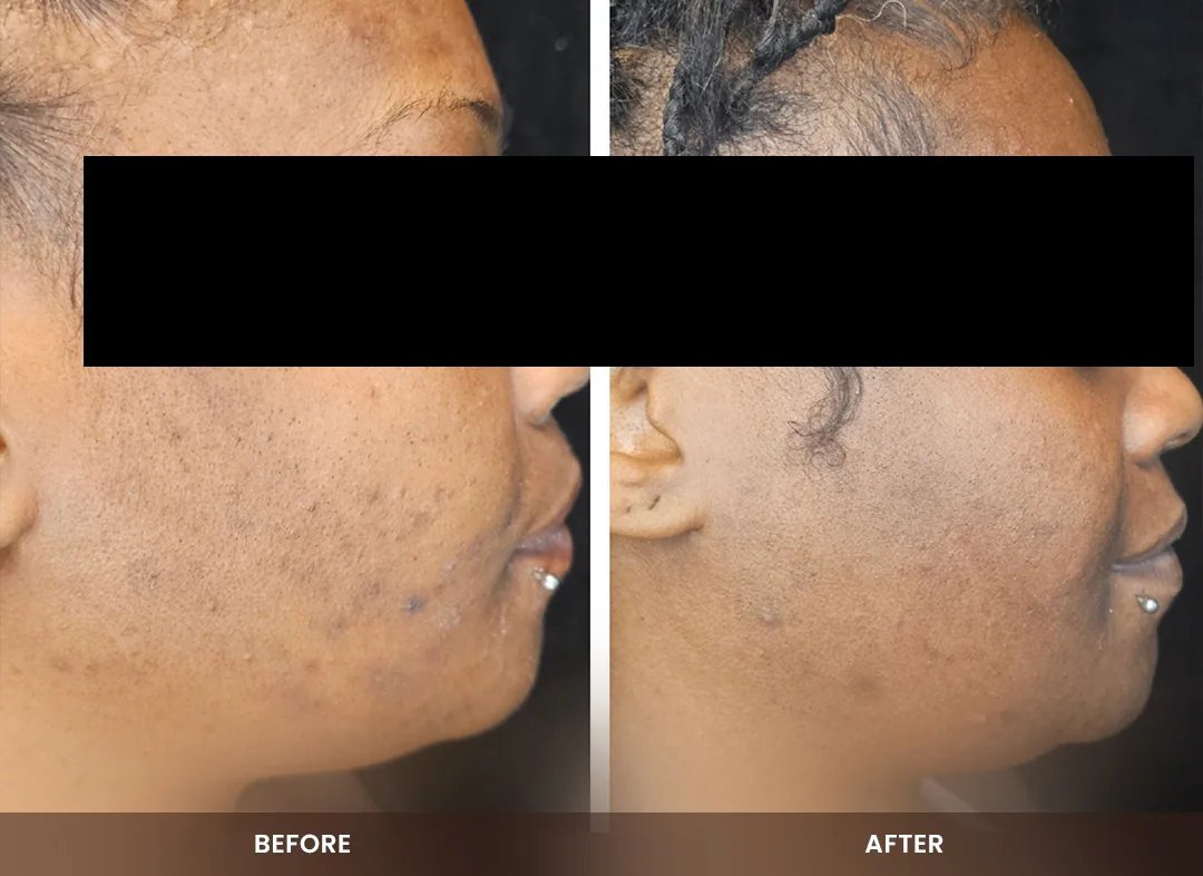 Skin Tightening before and after result — Face & jawline
