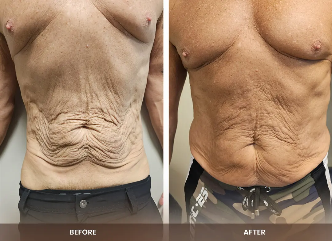 Skin Tightening before and after result — Abdomen