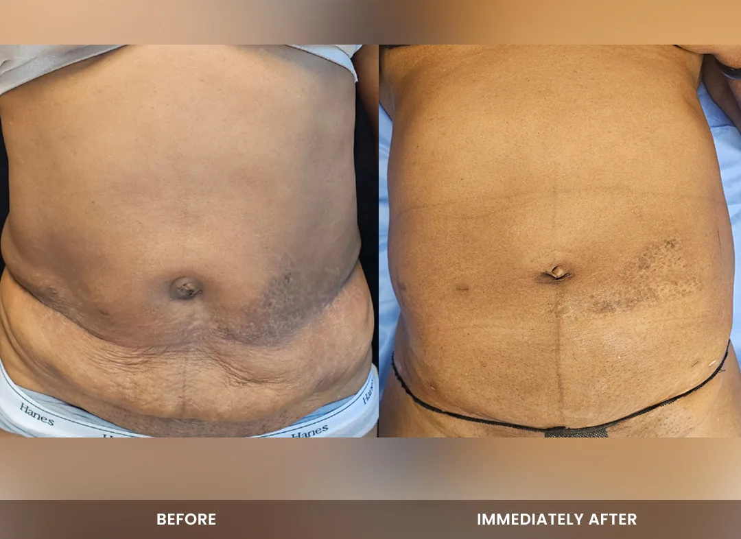 Laser Liposuction before and after result — Abdomen