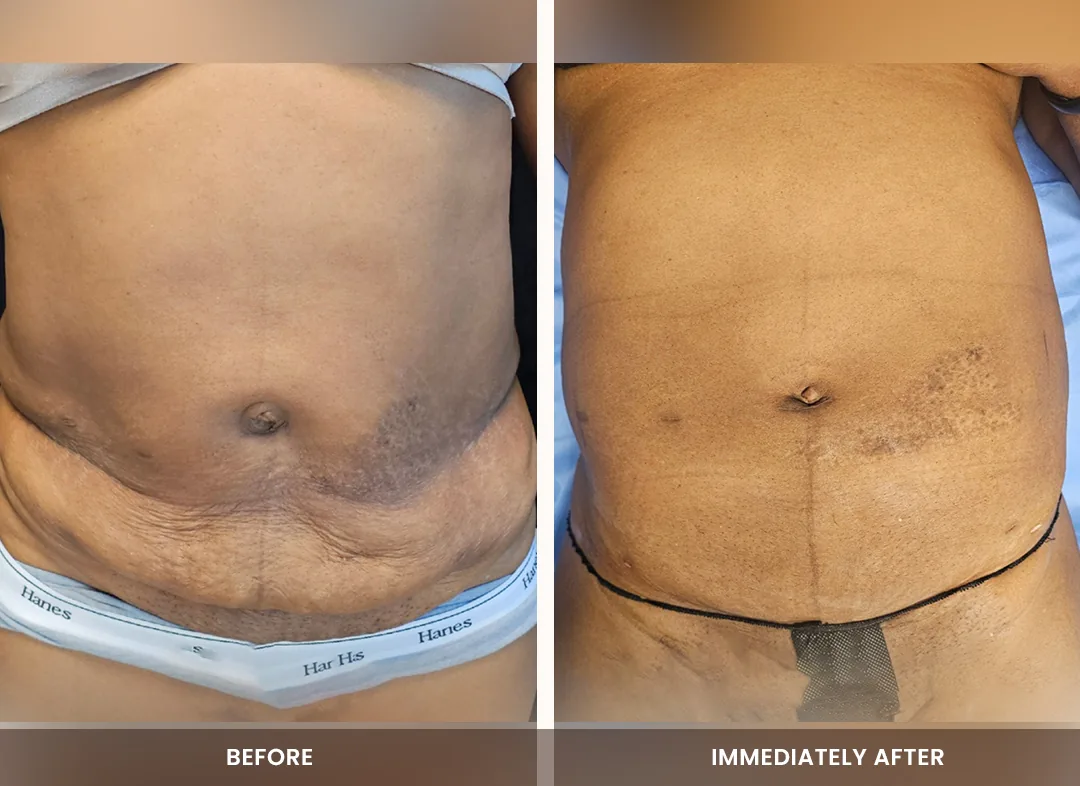 Laser Liposuction before and after result — Abdomen