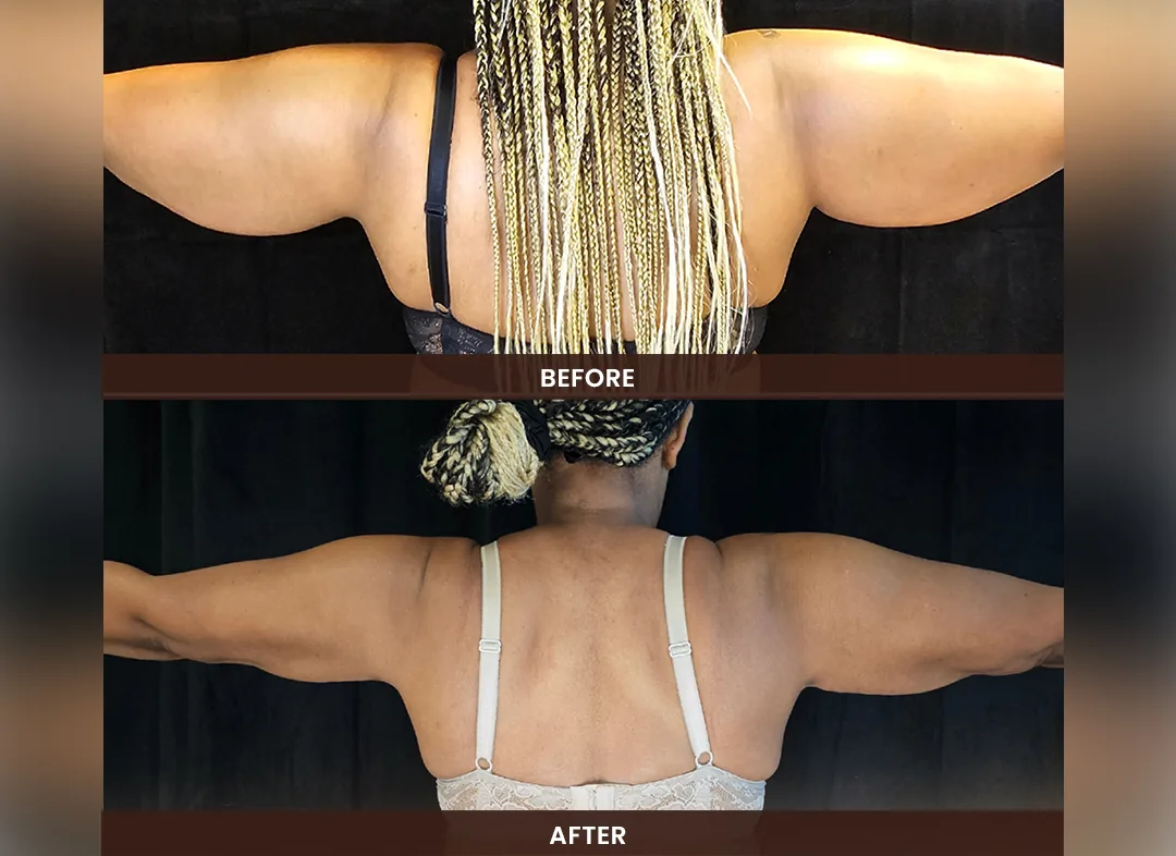 Laser Liposuction before and after result — Upper arms