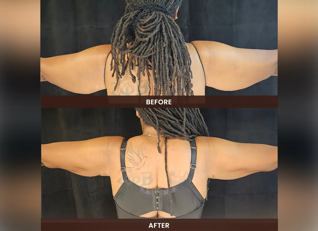 Laser Liposuction before and after result — Upper arms