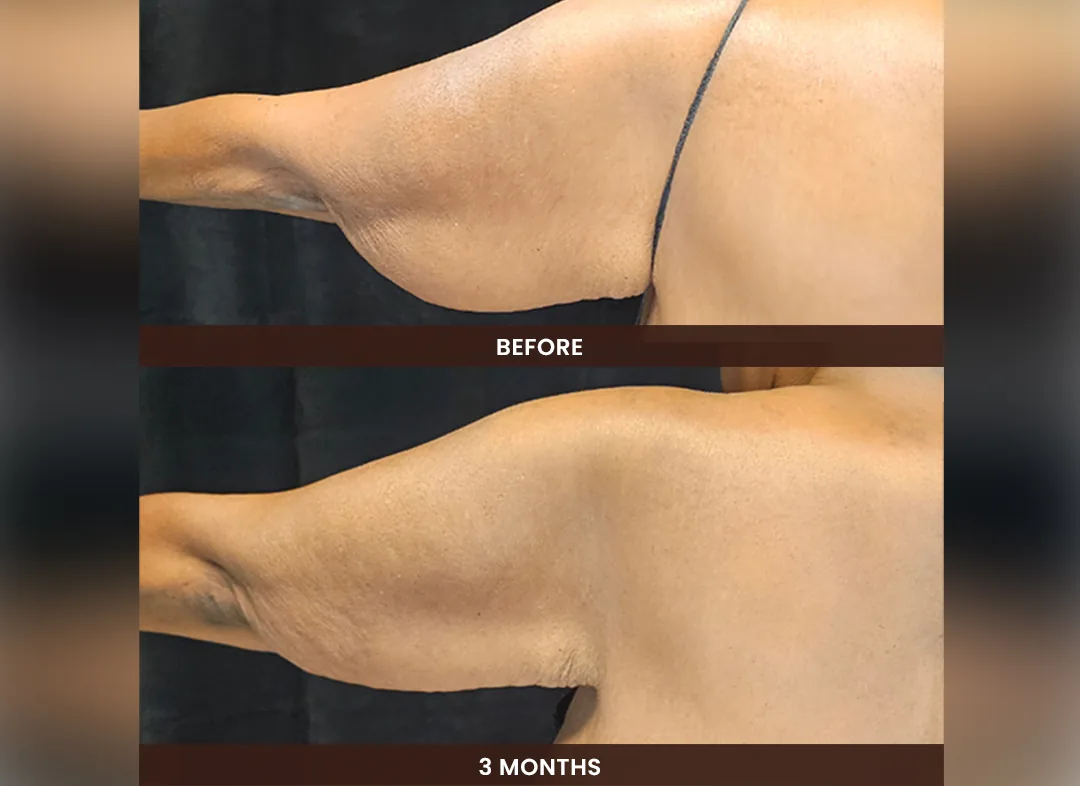 Laser Liposuction before and after result — Upper arm