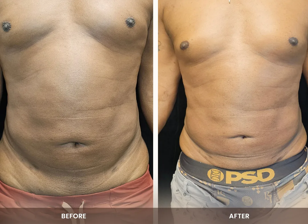 Laser Liposuction before and after result — Chest & abdomen