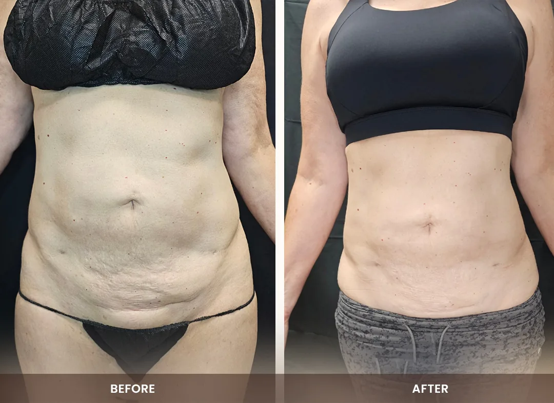 Laser Liposuction before and after result — Abdomen