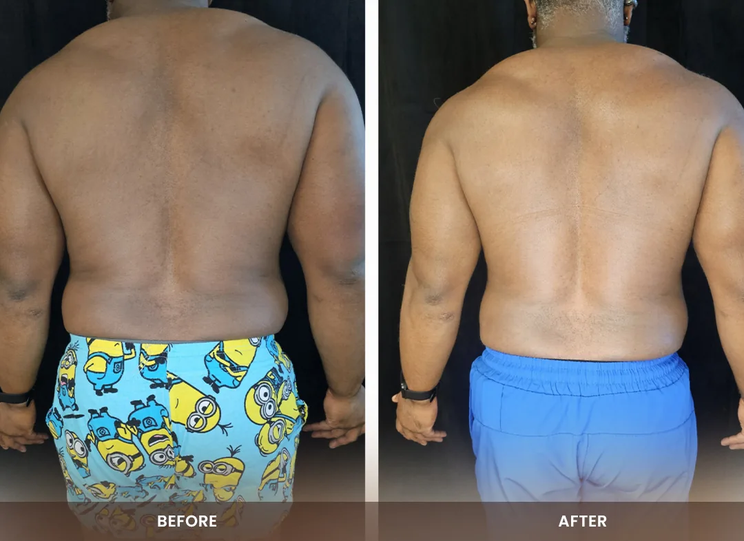 Contour Light® before and after result — Back & flanks