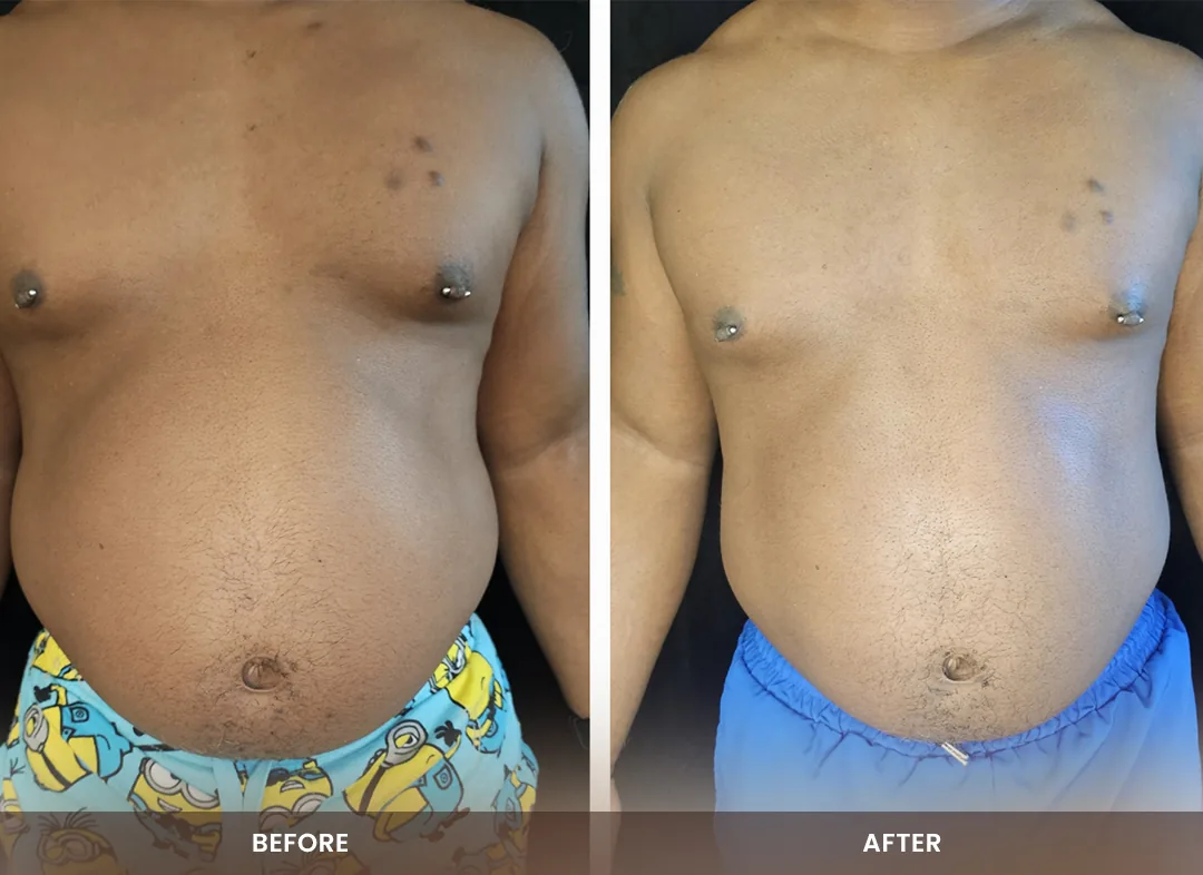 Contour Light® before and after result — Chest & abdomen