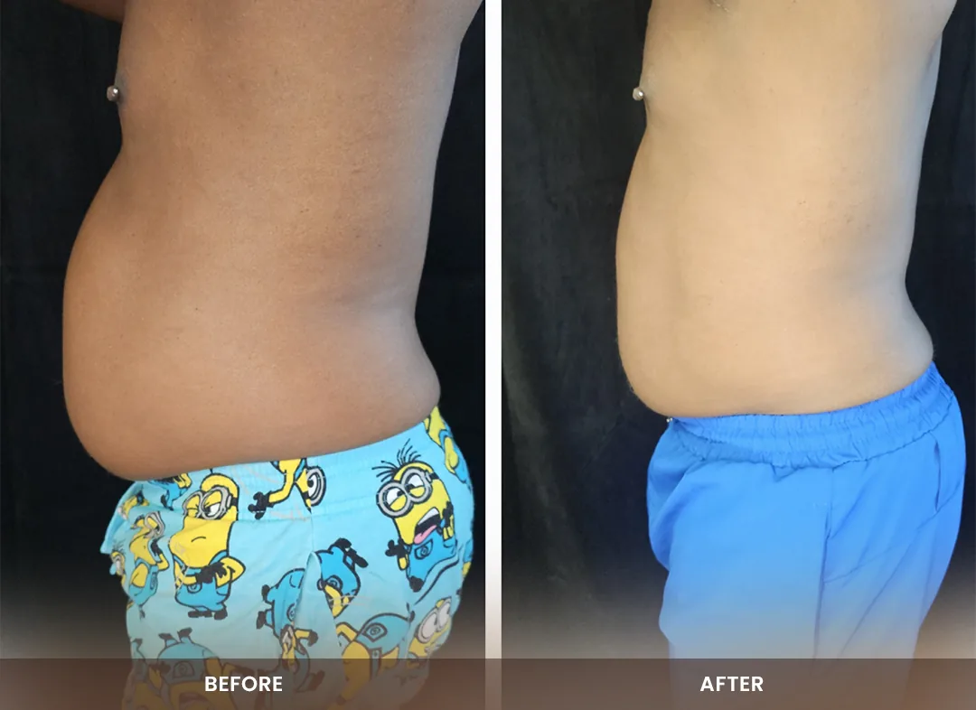 Contour Light® before and after result — Abdomen
