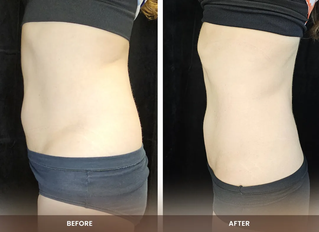 Contour Light® before and after result — Abdomen & waist