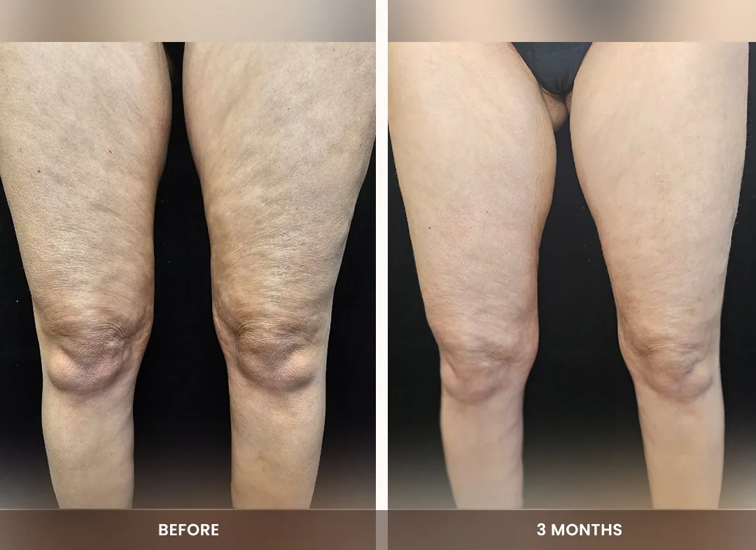 Skin Tightening before and after result — Thighs & knees