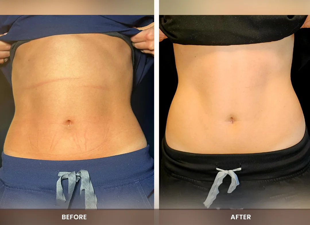 Muscle Building before and after result — Abdomen