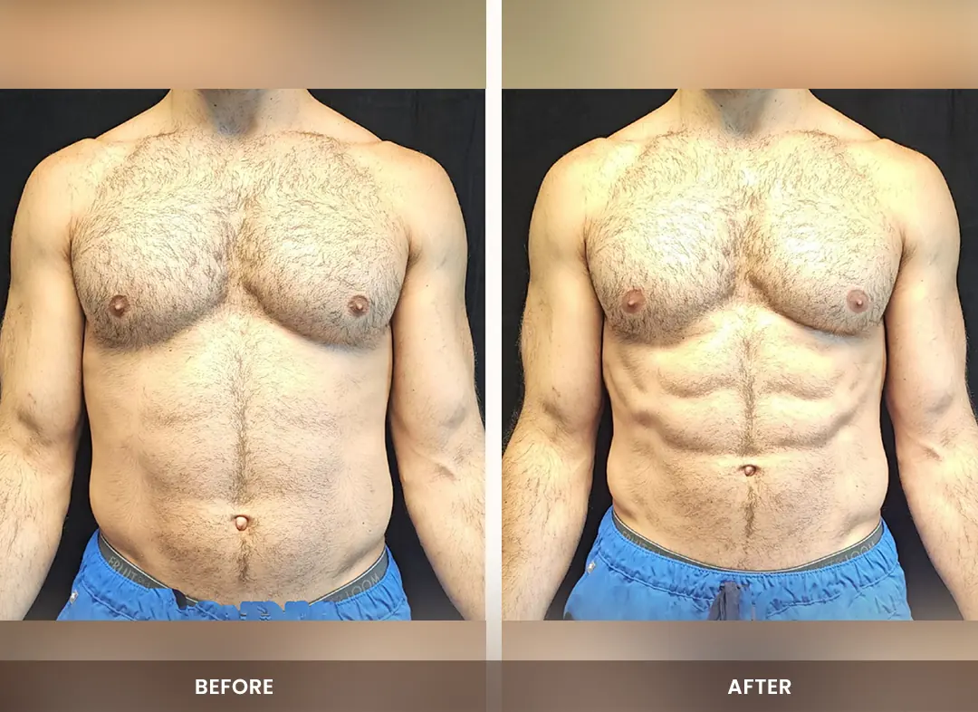 Muscle Building before and after result — Chest & abdomen