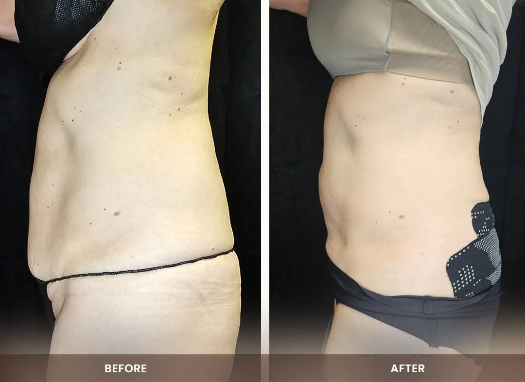 Muscle Building before and after result — Abdomen