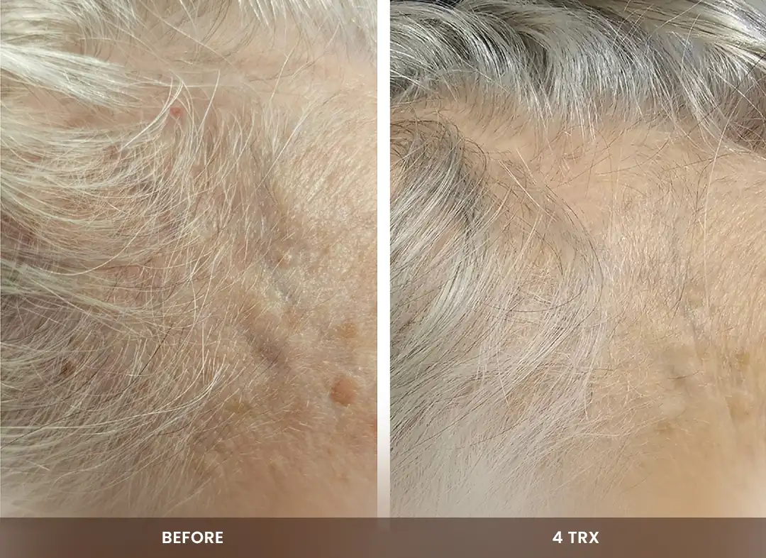 Hair Restoration before and after result — Scalp