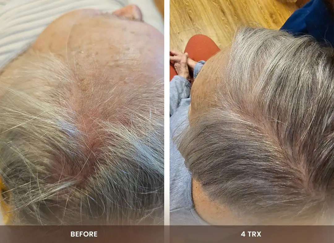 Hair Restoration before and after result — Crown