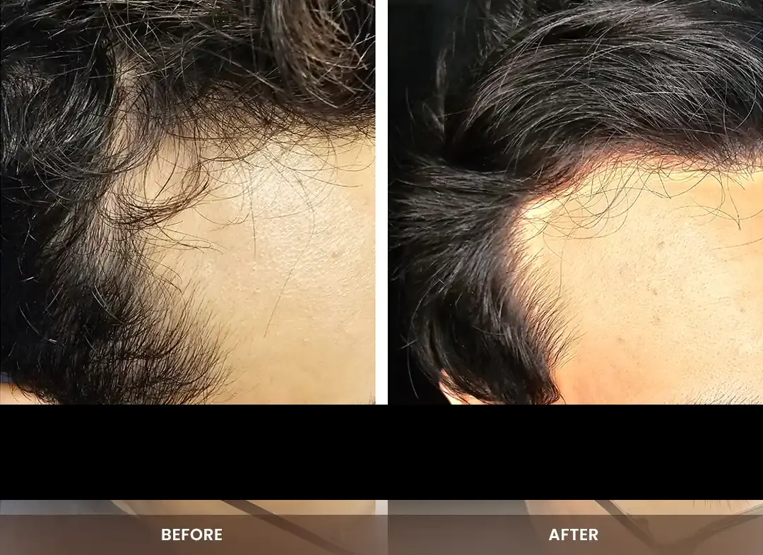 Hair Restoration before and after result — Hairline & temple