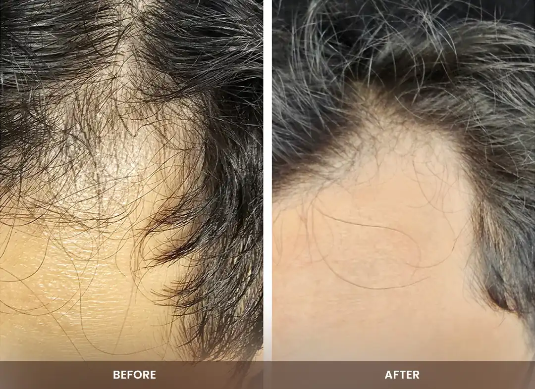 Hair Restoration before and after result — Hairline