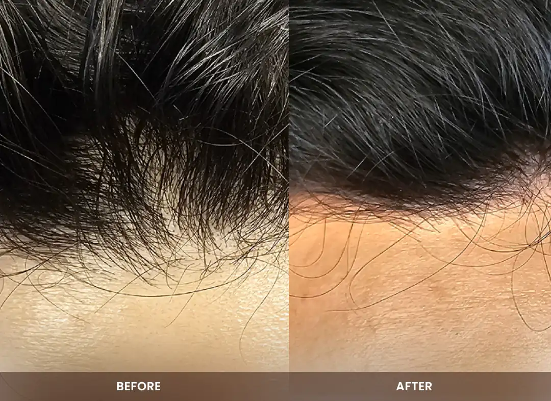 Hair Restoration before and after result — Hairline