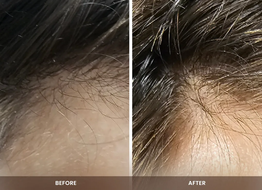 Hair Restoration before and after result — Crown