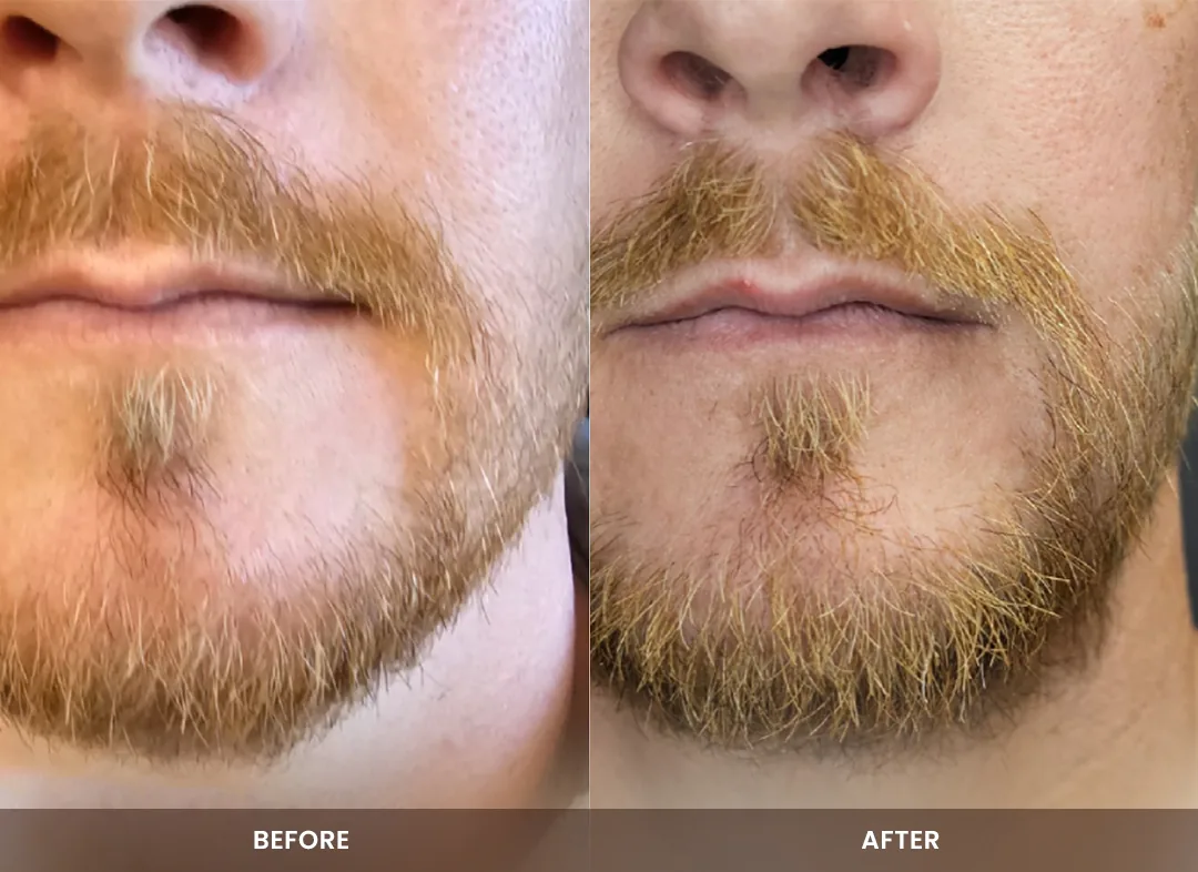 Hair Restoration before and after result — Beard