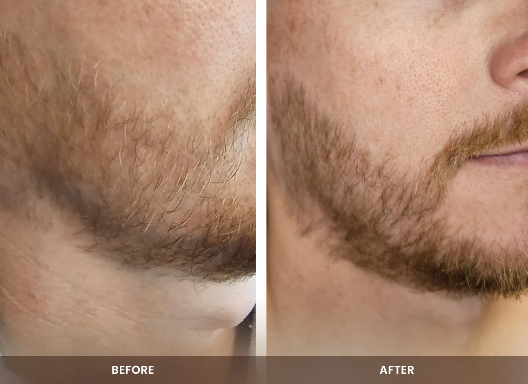 Hair Restoration before and after result — Beard