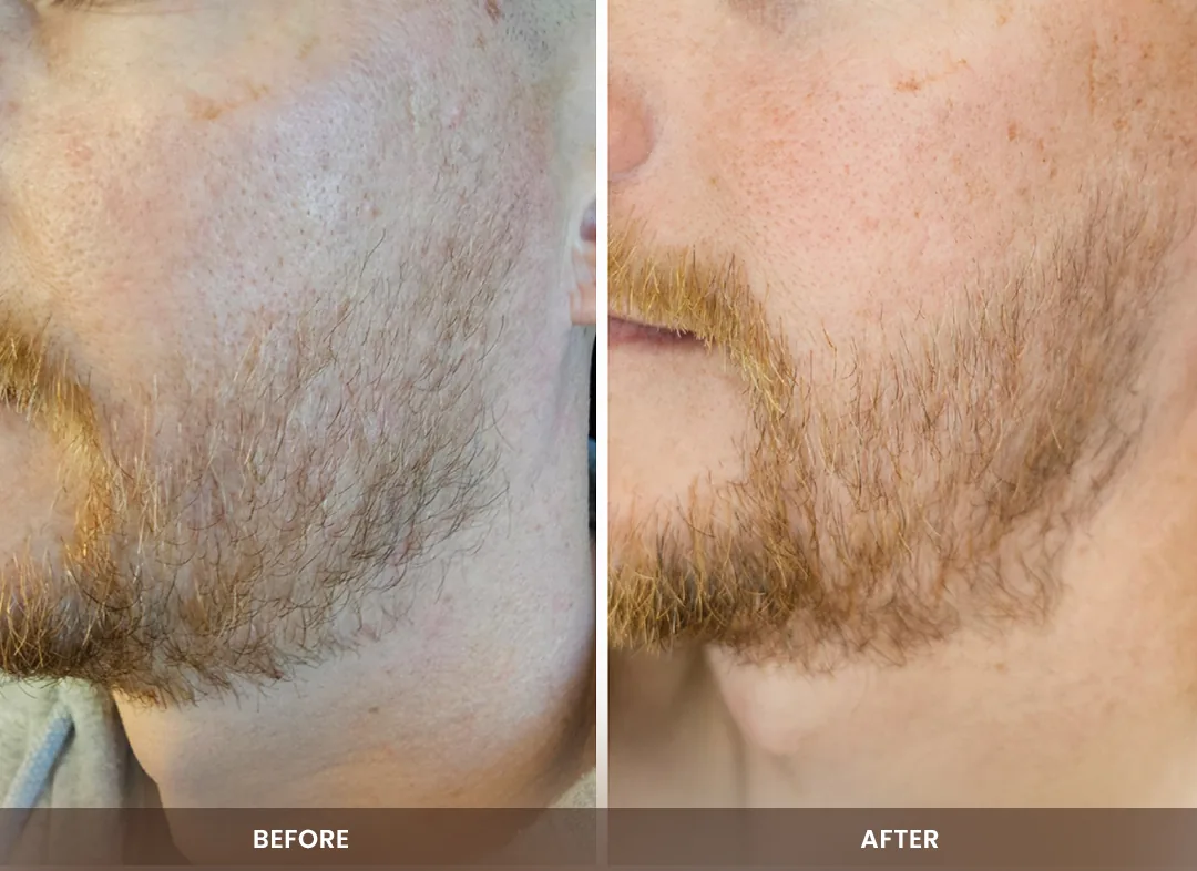 Hair Restoration before and after result — Beard