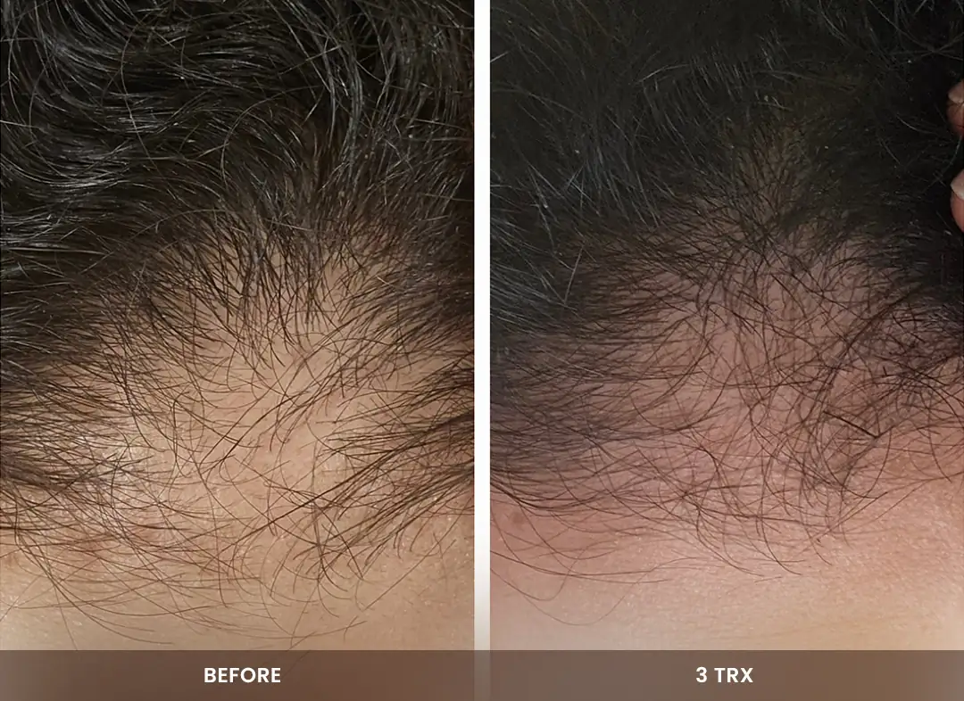 Hair Restoration before and after result — Crown