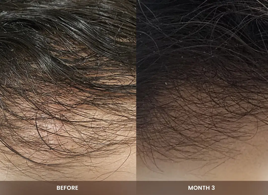 Hair Restoration before and after result — Scalp