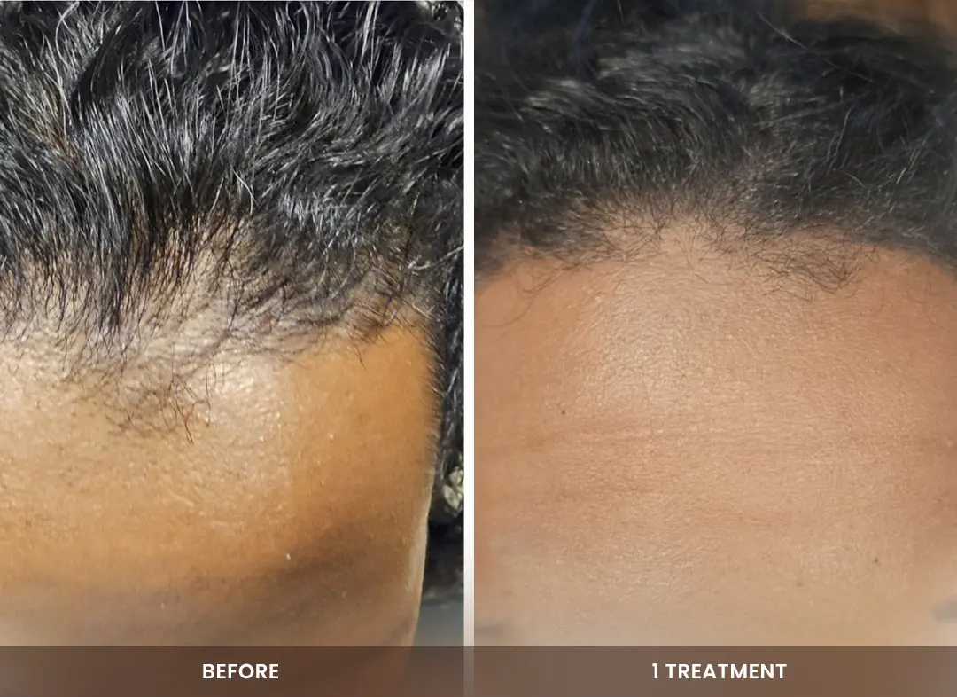 Hair Restoration before and after result — Hairline