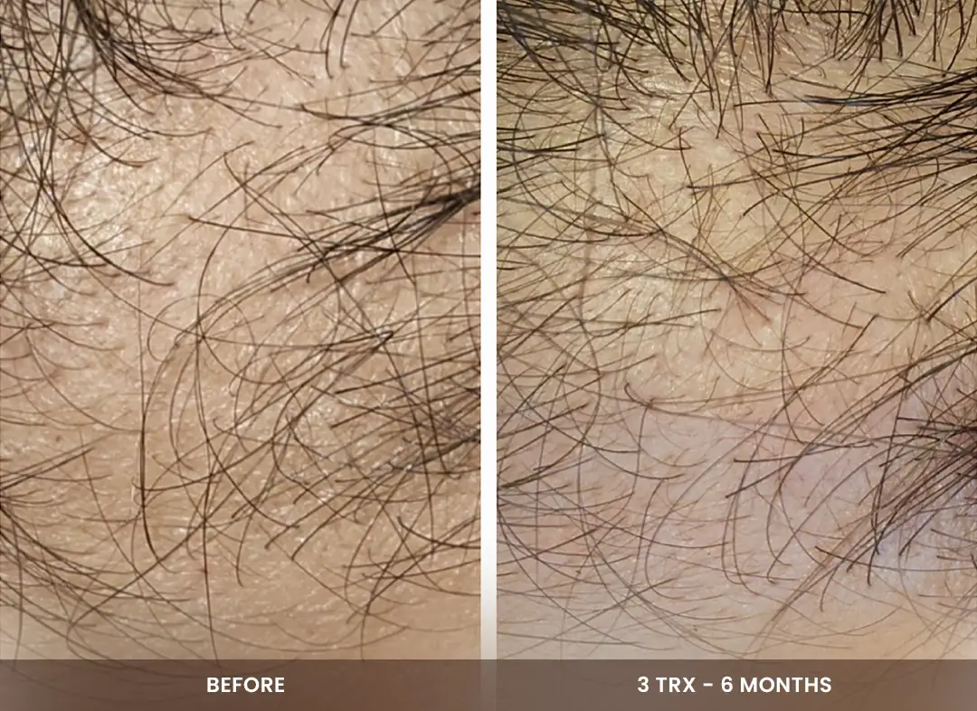 Hair Restoration before and after result — Scalp
