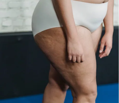 Fat that stays on the outer thigh at a stable weight