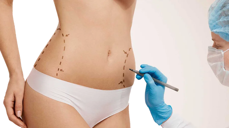 Laser Liposuction & Liposculpting